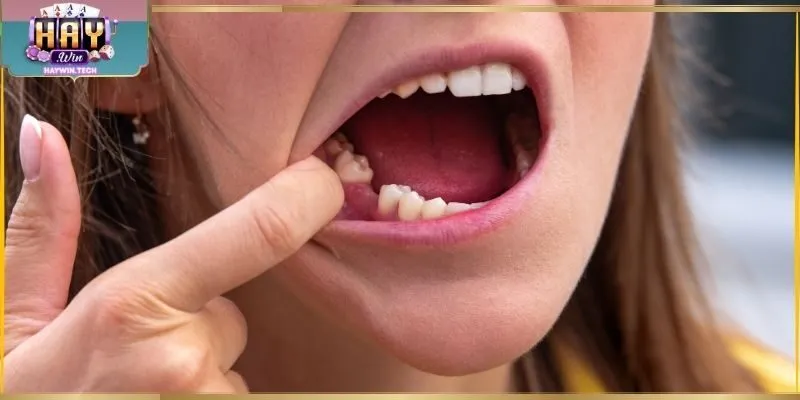 Mơ thấy răng rụng