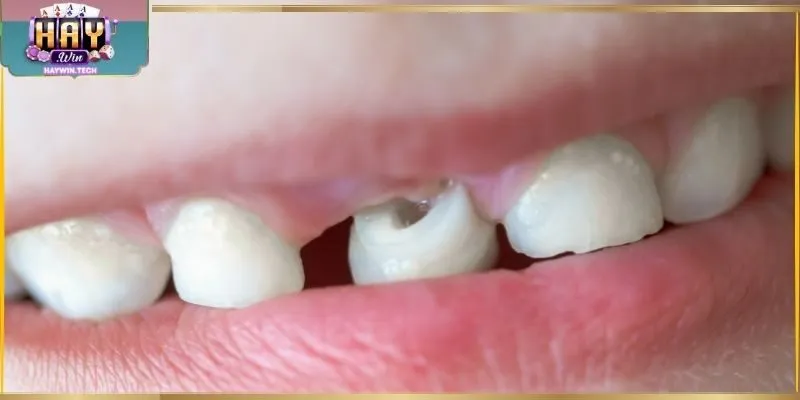 Nằm mơ thấy mất răng một chiếc