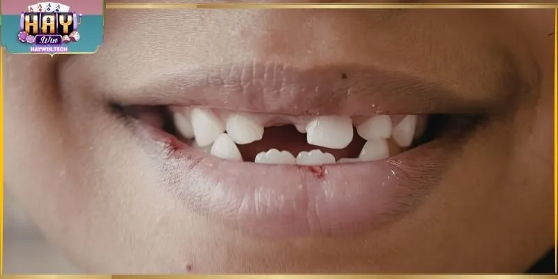 Nằm Mơ Thấy Mất Răng